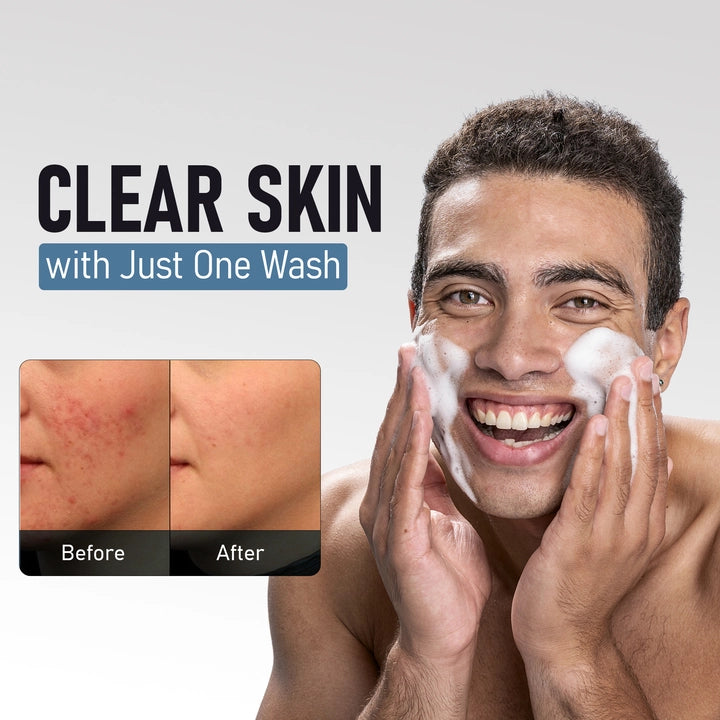 Anti Acne & Spots Reduction Face Wash